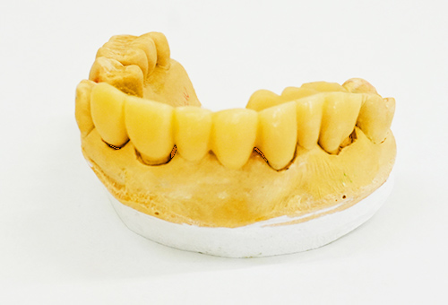 院長がこだわって製作する入れ歯